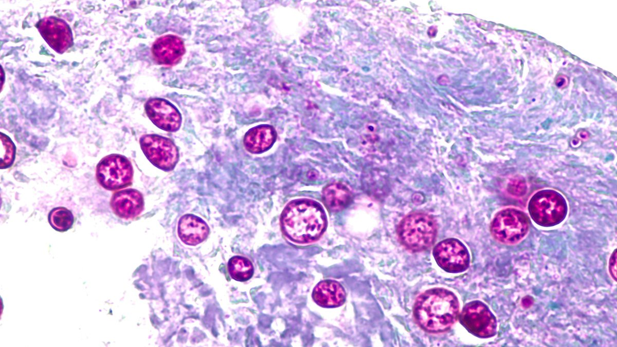 Cyclosporiasis cases in Florida, U.S. could be undercounted, experts say 